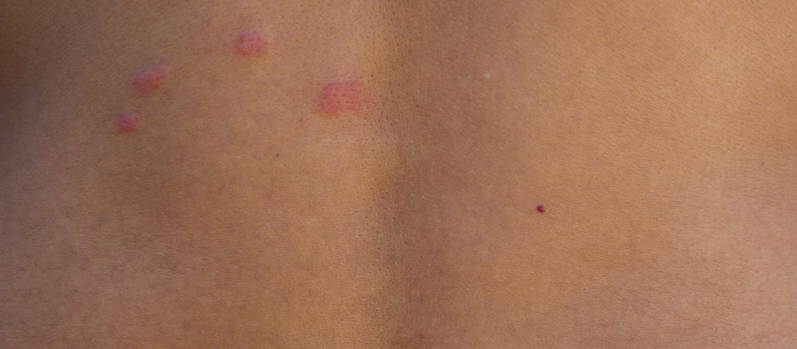 Different Reactions to Bed Bug Bites